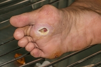 Wounds on the Feet May Be a Serious Condition