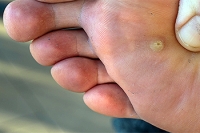 What Causes Plantar Warts?