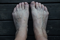 A Bunionette Is Known as a Tailor’s Bunion