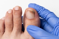 Symptoms and Overview of Toenail Fungus