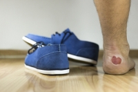 Common Causes of Blisters